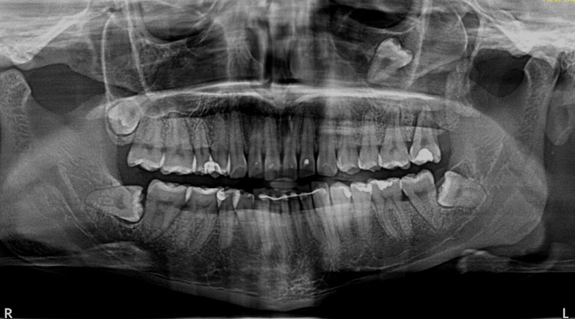 ¿Estamos perdiendo las muelas del juicio? Esto es lo que dice la ciencia